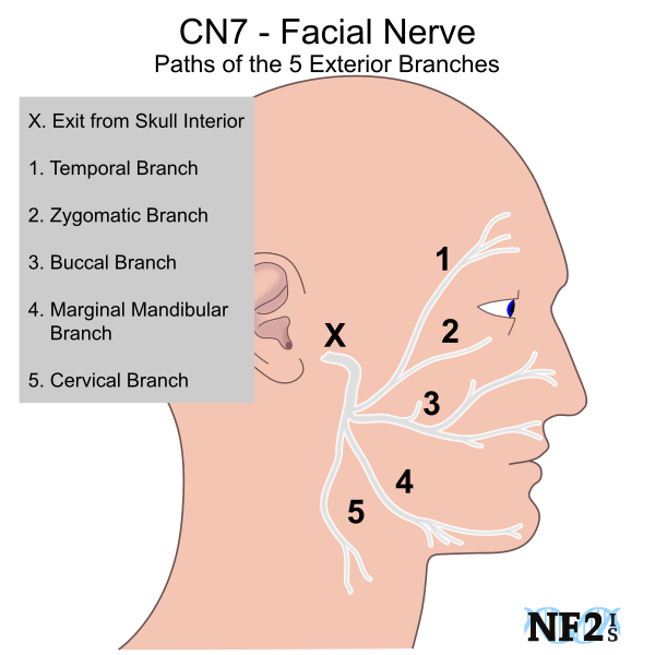 Cn Facial Nerve Damage