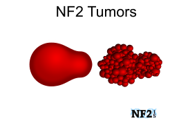 NF2 Tumors