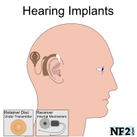 NF2 Issue