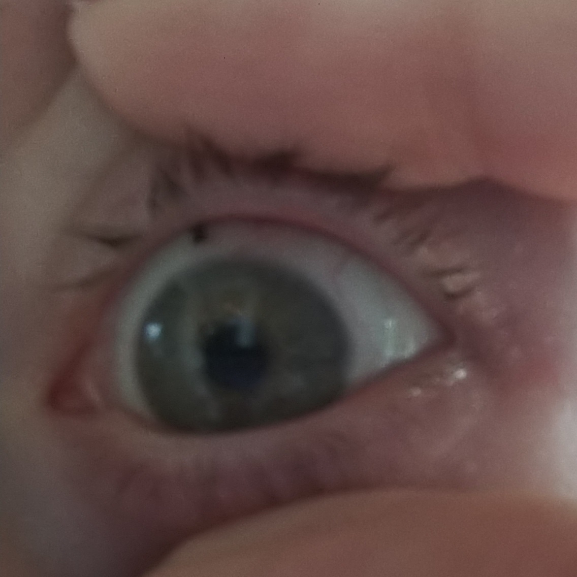 Sclera Lenses, dry eye treatment