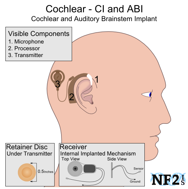 Cochlear - System Components