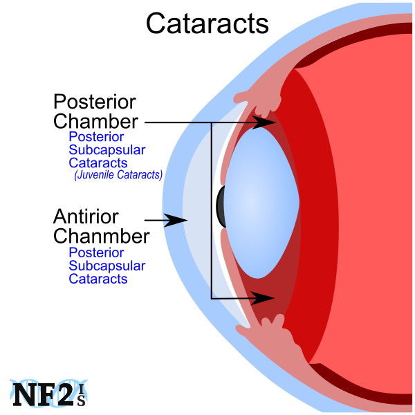 Cataracts, Anterior Chamber, Posterior Chamber, 
Retinal Blood Vessels, Retina, Cornea, Optic Nerve, Macula, Capsular Cataracts