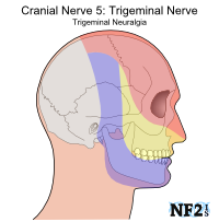 NF2 Issue