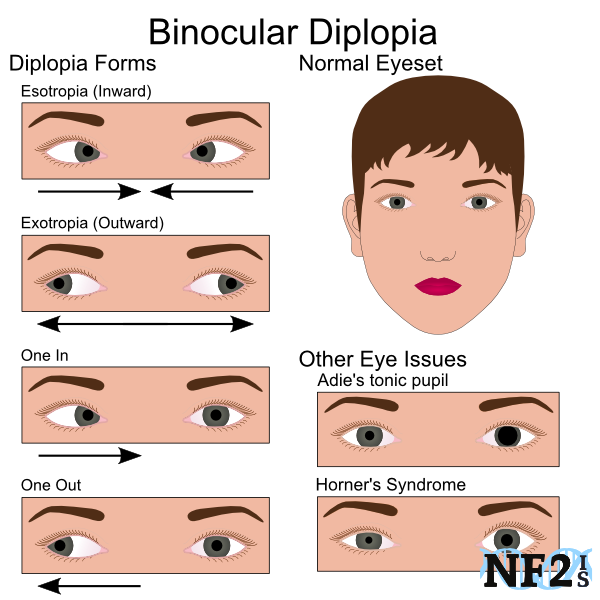 Binocular Diplopia, Strabismus, esotropia, exotropia, adie tonic pupil, hormer's syndrome