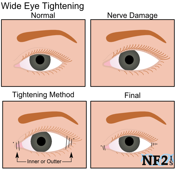 Eye Tightening, nerve damage, tightening method, surgery