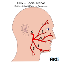 NF2 Issue