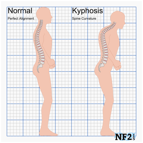 Kyphosis