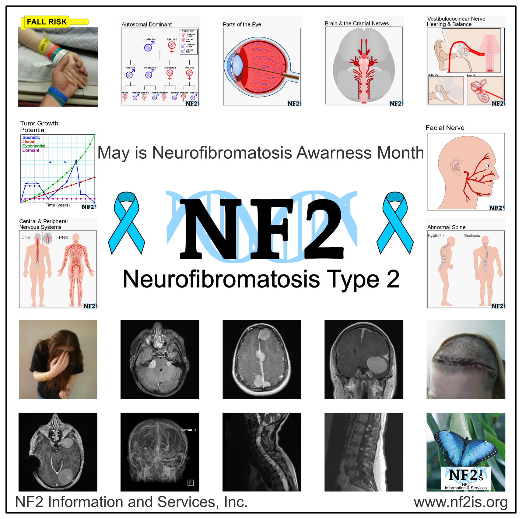 May is NF (Neurofibromatosis) Awareness Month