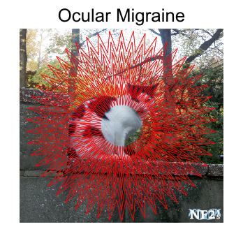 Migraine, eye, Ocular Migraine, Retinal Migraine, vision migraine