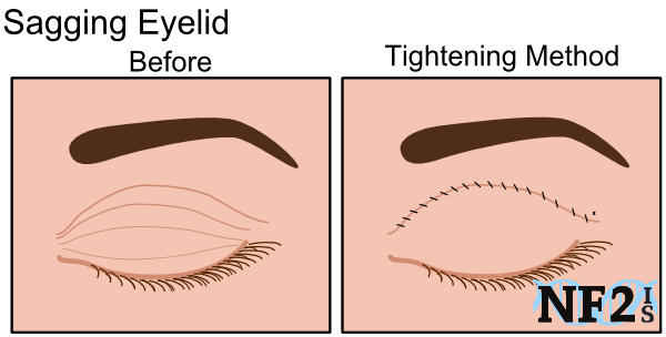 Sagging Eyelid, surgery, tightening method