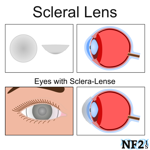 Sclera Lenses, Scleral Lens