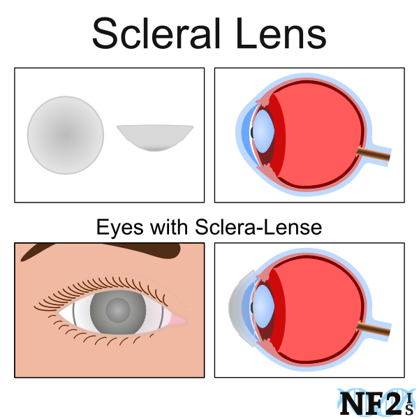 Sclera Lenses, dry eye treatment