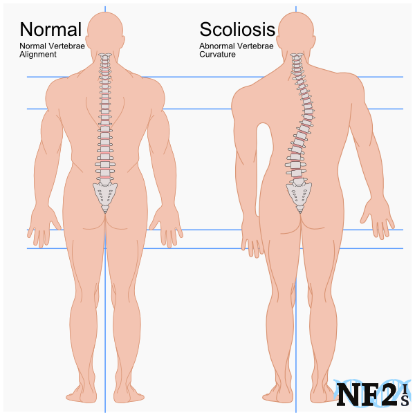 Scoliosis