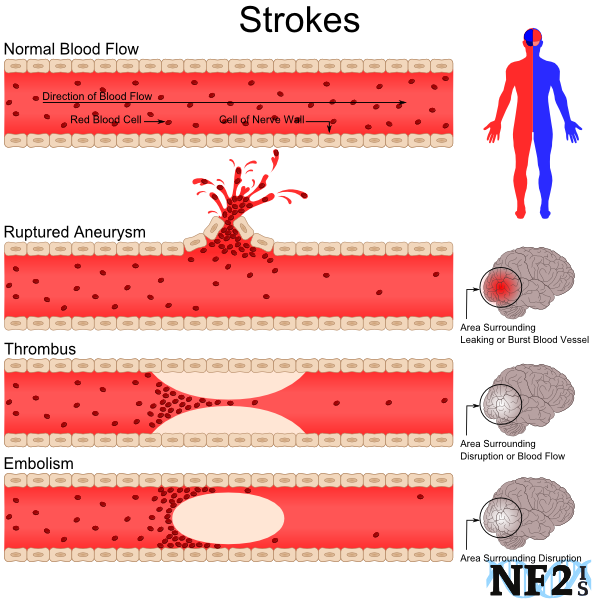 stroke types