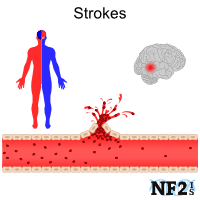 NF2 Issue