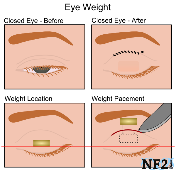 Eye Weight Placement, surgical